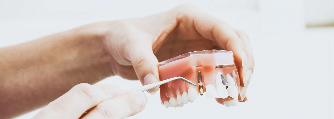 Čelične konstrukcije | Zubni implanti Beograd